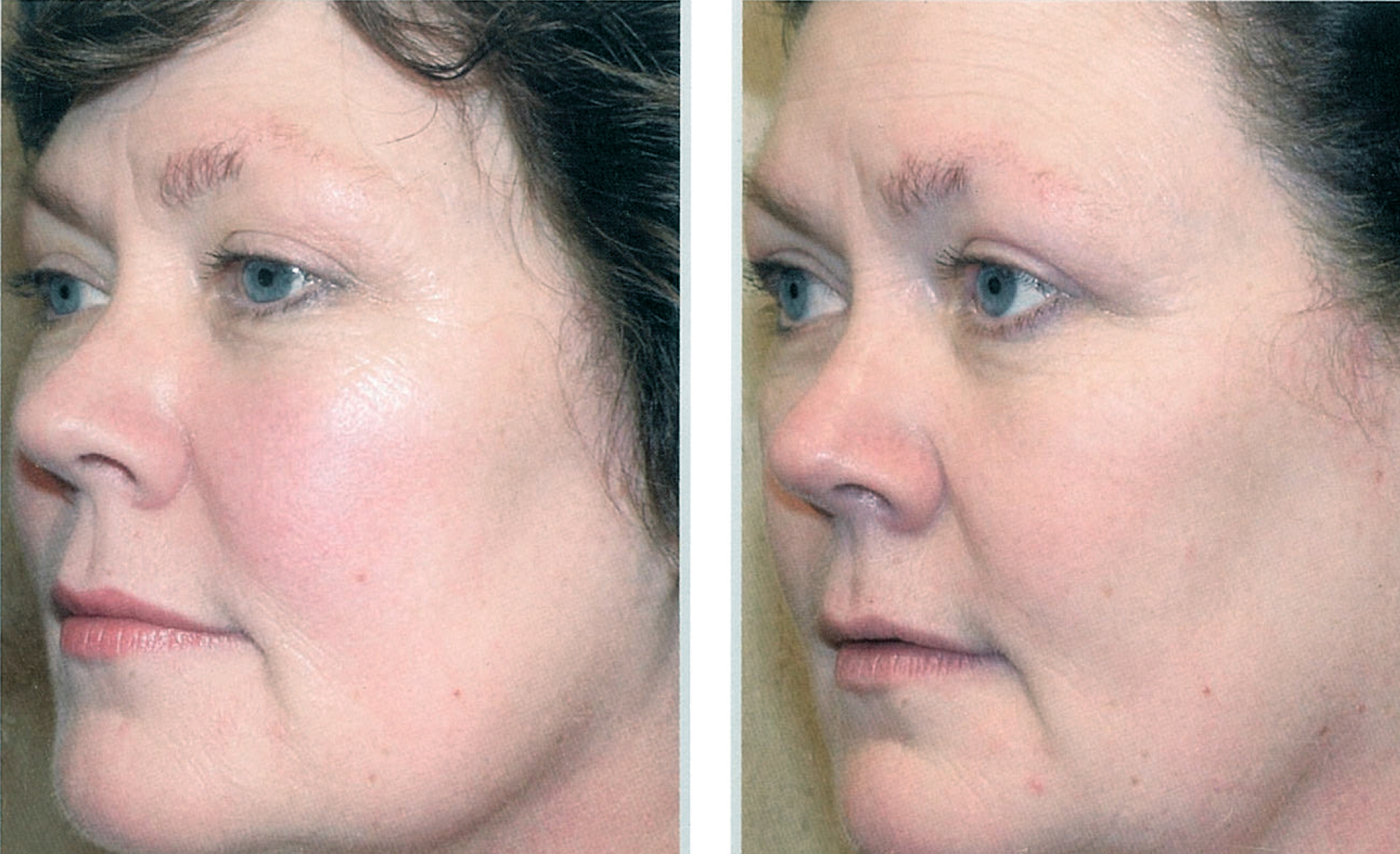 Check out these before and after BBL treatments.